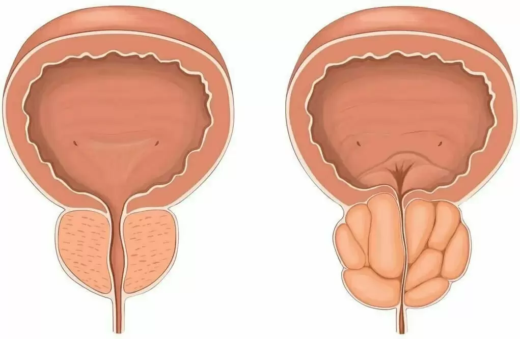 Healthy prostate and prostate