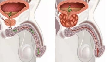 Prostatitis