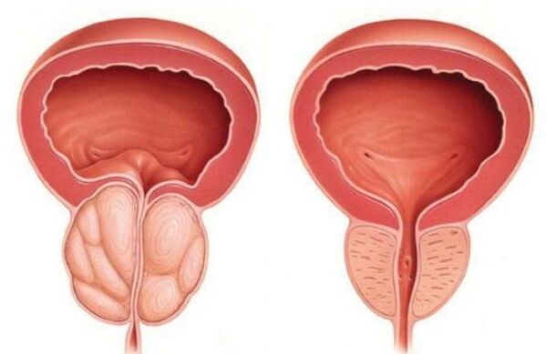 normal prostate and enlarged prostate