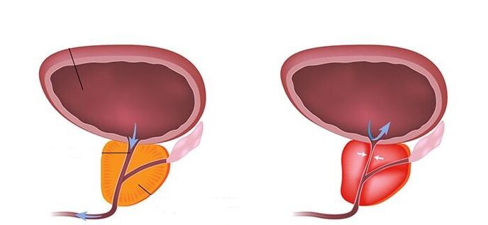 healthy prostate and inflamed prostate